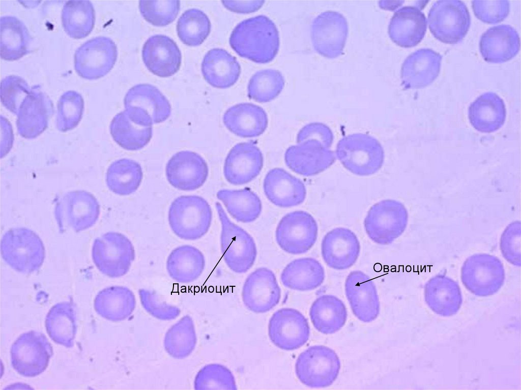 Эритроциты в мазке. Мишеневидные клетки в мазке. Каплевидные эритроциты в мазке крови. Эритроциты синие. Мазок крови эритроциты в мазке.