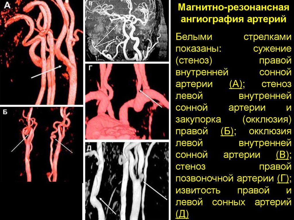 Сужение правой артерии. Анатомия брахиоцефальных артерий кт. Кт ангиография интракраниальных артерий. Протокол кт-ангиографии сосудов мозга. Кт ангиография артерий шеи.