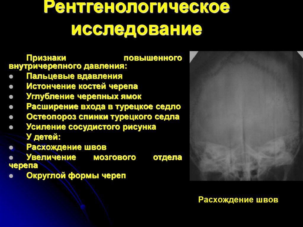 Рентген признаки. Рентген признаки внутричерепной гипертензии. Внутричерепная гипертензия рентген. Внутричерепное давление рентген. Пальцевые вдавления на рентгенограмме черепа.