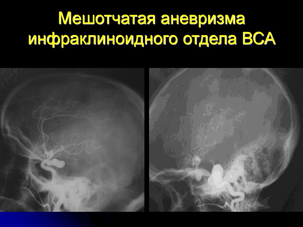 Мешотчатые аневризмы вса. Мешотчатая аневризма сосудов головного мозга. Аневризма супраклиноидного отдела ВСА. Аневризма инфраклиноидного отдела ВСА. Мешотчатая аневризма ВСА.