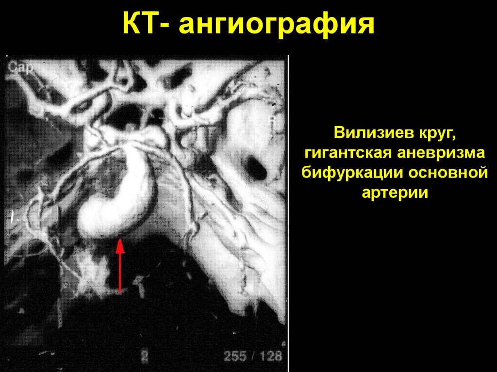 Гипоплазия задних артерий. Аневризма основной артерии мрт. Задняя соединительная артерия мрт. Аневризма задней соединительной артерии на мрт. Аневризма селезеночной артерии клинические рекомендации.