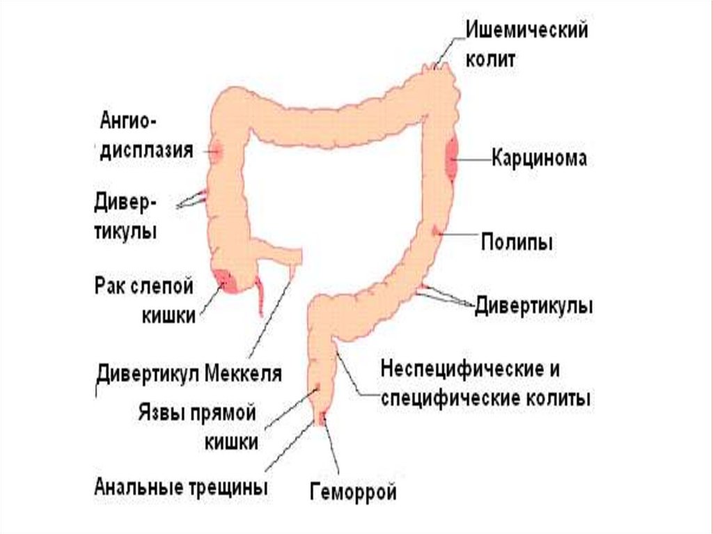 Поверхностный колит. Ишемический колит локализация. Ишемический колит этиология. Ишемический колит кишечника.