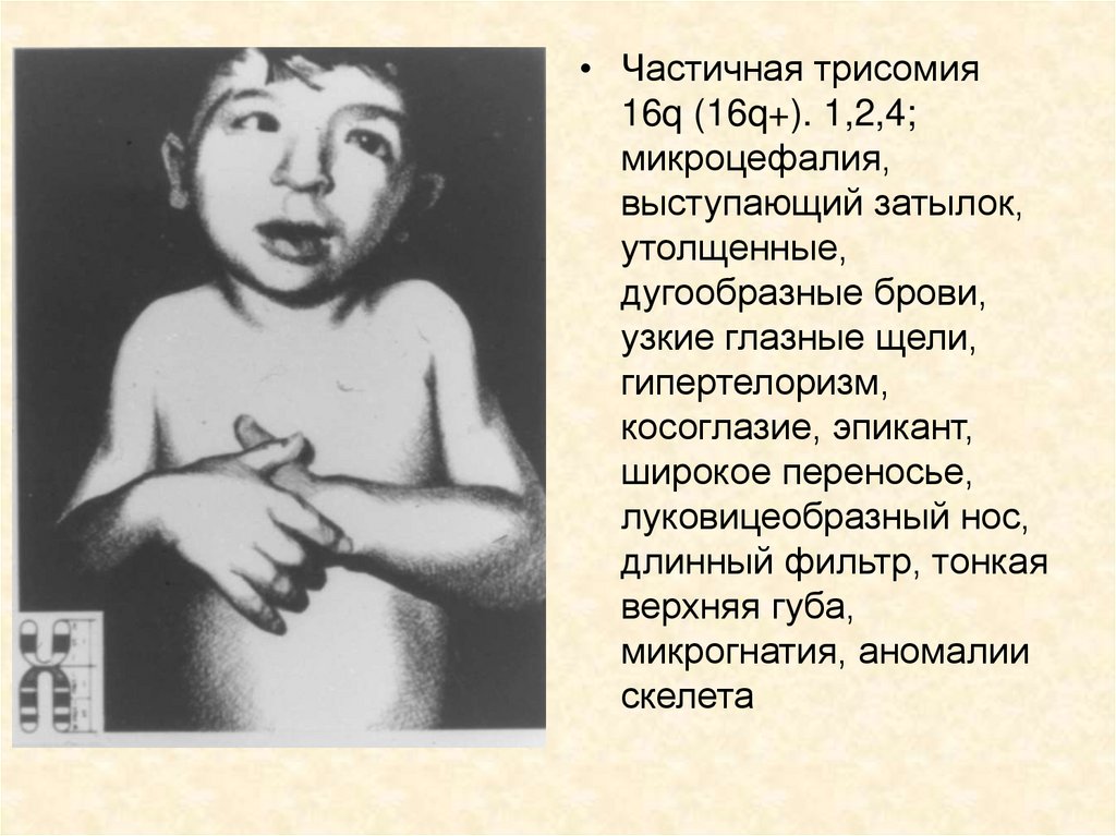 Трисомия это. Гипертелоризм синдром Патау. Трисомия по 16 хромосоме. Синдром частичной трисомии.