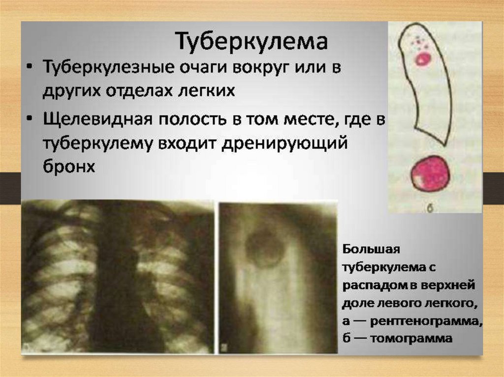 Туберкулема. Туберкулома рентген признаки. Туберкулома туберкулез рентген. Туберкулема рентгенологические признаки. Туберкулема форма туберкулеза.