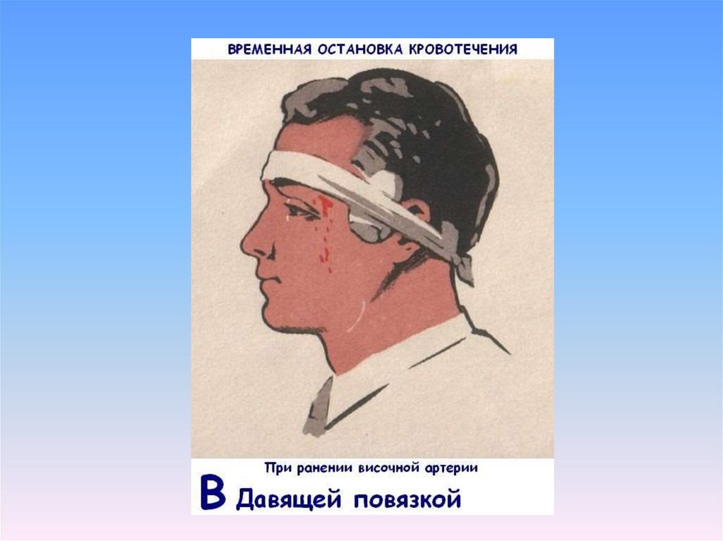 Н давить. Способы остановки кровотечения при ранении головы. Наложение давящей повязки на височную артерию.