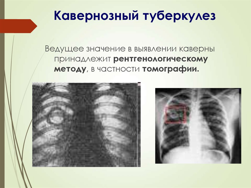 Информация о туберкулезе. Кавернозный туберкулез легких кт. Кавернозный туберкулез легких.
