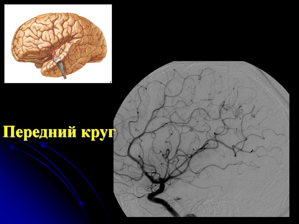 Сосудистые поражения головного мозга. Сосудистые заболевания головного мозга. Инфраклиноидная аневризма.