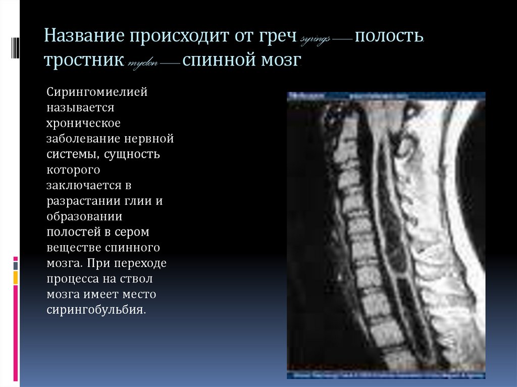 Сирингомиелия