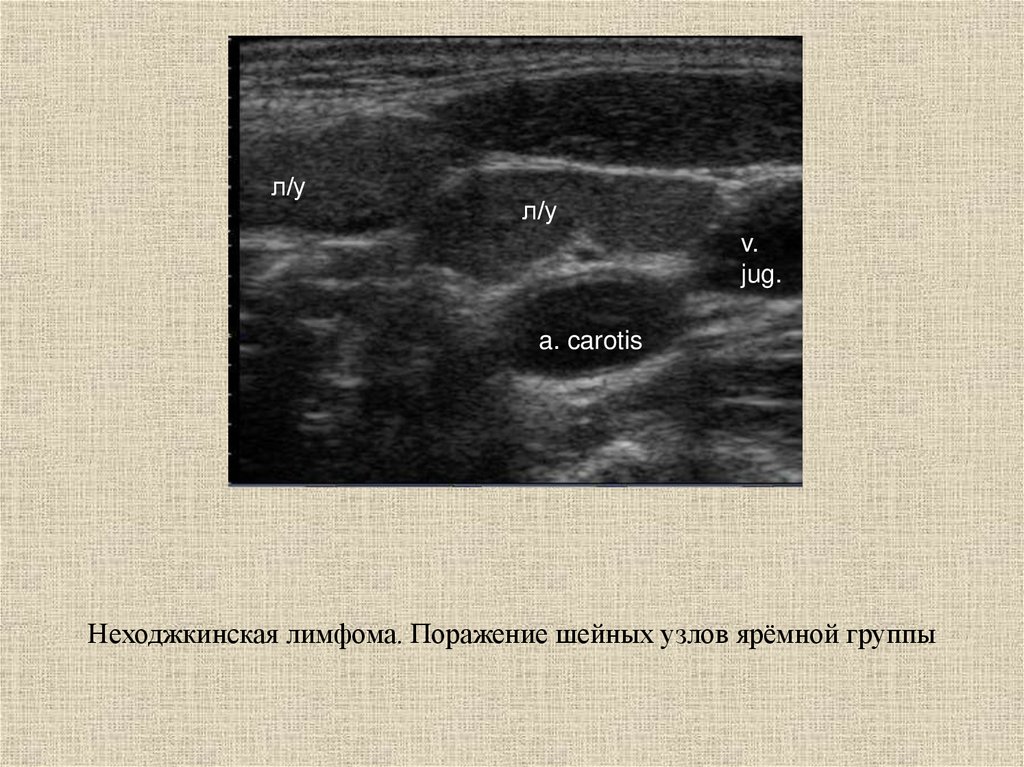 Узи лимфатических. Лимфома неходжкинская УЗИ лимфоузлов. УЗИ лимфатических узлов норма. Лимфогранулематоз УЗИ лимфоузлов. Лимфома Ходжкина на УЗИ лимфоузлов.