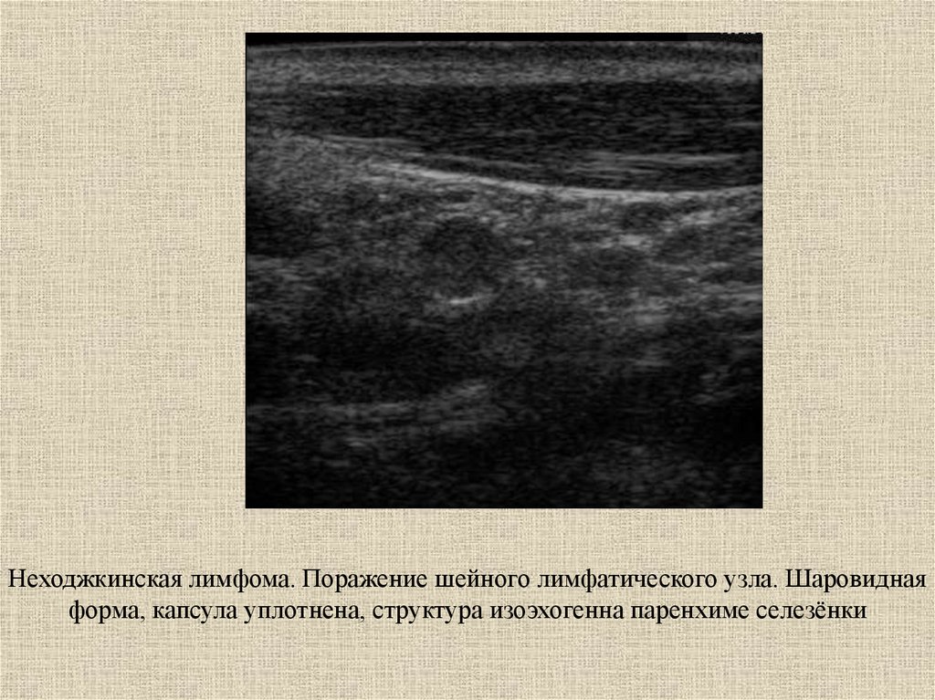 Узи лимфатических узлов. Лимфома неходжкинская УЗИ лимфоузлов. Лимфогранулематоз УЗИ лимфоузлов. Лимфатические узлы при лимфоме на УЗИ. Лимфогранулематоз селезенки УЗИ.