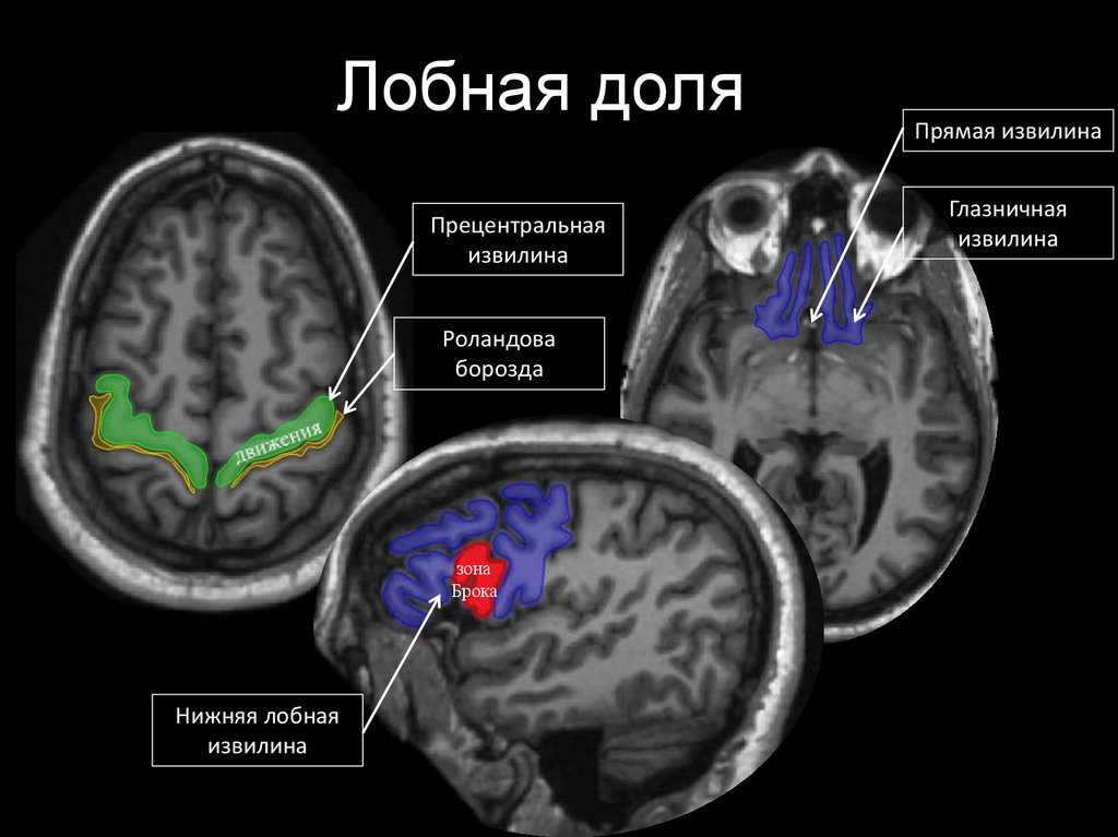 Лобно теменная область мозга. Анатомия височной доли мрт. Прецентральная извилина мрт. Извилины головном мозге анатомия мрт. Лобные извилины мрт анатомия.