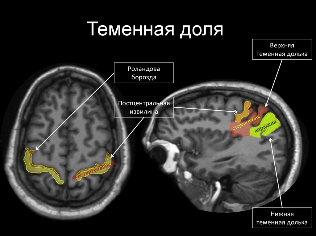 Лобно теменная область мозга. Лобные извилины мрт анатомия. Доли головного мозга на кт анатомия. Доли головного мозга мрт анатомия.