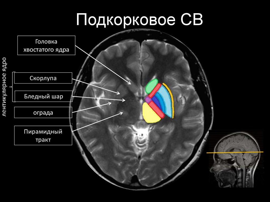 Изменение в базальных отделах. Базальные ядра головного мозга анатомия кт. Анатомия подкорковых ядер мрт. Базальные ядра головного мозга анатомия мрт. Подкорковые структуры мозга на мрт.