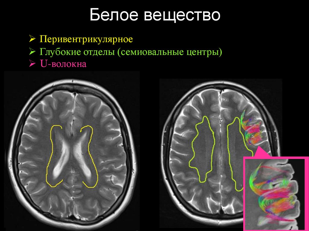 Изменение в базальных отделах. Семиовальные центры в головном мозге. Перивентрикулярная лейкомаляция кт. U образные волокна головного мозга. Базальные ядра головного мозга анатомия кт.