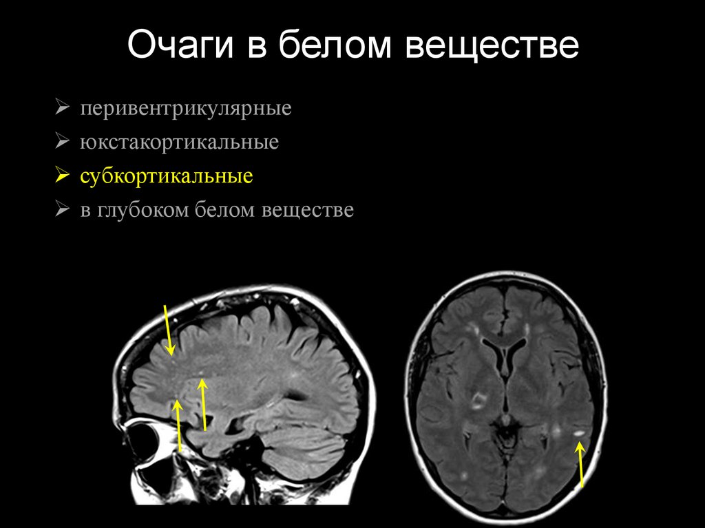 Глиоз полушарий мозга. Субкортикальные очаги головного мозга. Субкортикальные очаги в белом веществе головного мозга мрт. Очаги глиоза в головном мозге мрт. Демиелинизация спинного мозга мрт.