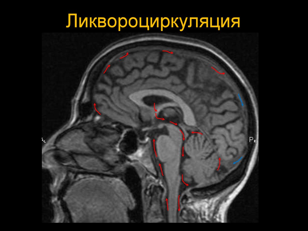 Цистерны мозга расширены. Киста цистерны четверохолмия кт. Цистерна Меккеля головной мозг. Ликвородинамика головного мозга мрт. Ликворная система головного мозга мрт.