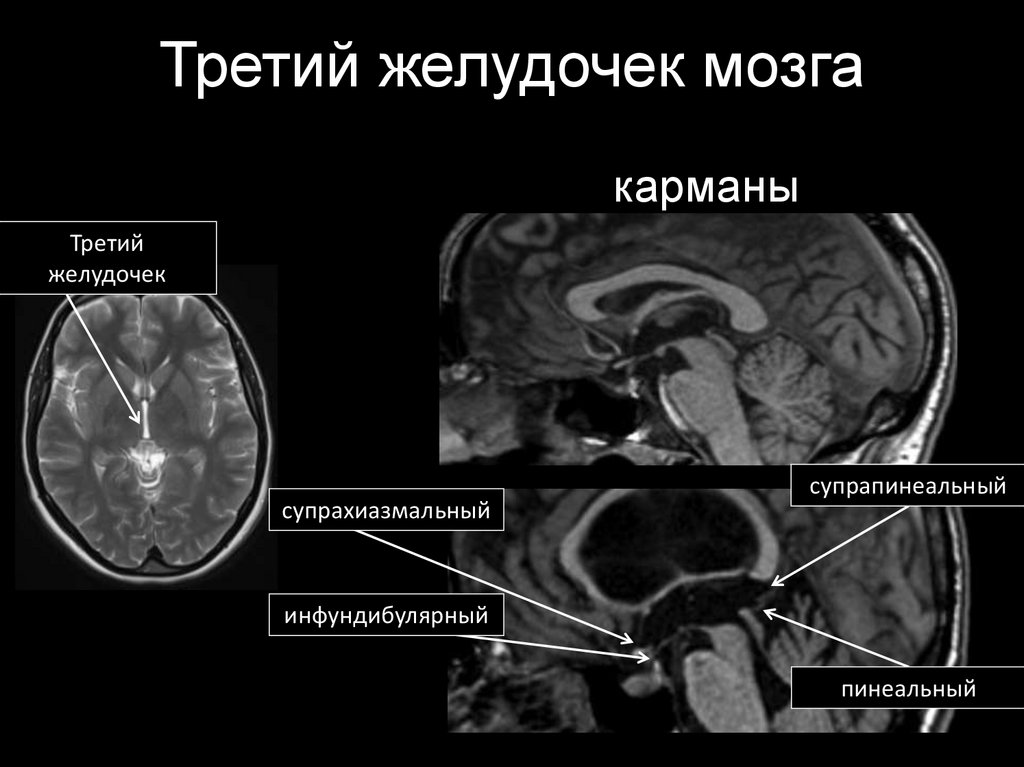 Норма желудочков мозга у взрослых. 4 Желудочек головного мозга анатомия мрт. 3 Желудочек головного мозга мрт. Желудочки головного мозга анатомия мрт. Мрт желудочков головного мозга в норме.