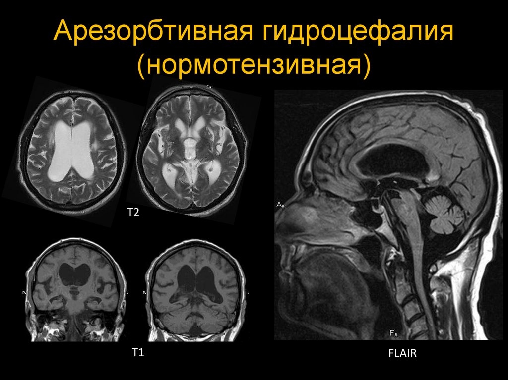 Последствия гидроцефалии головного мозга