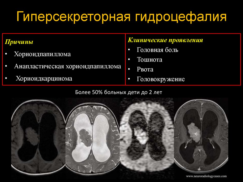 Диета при гидроцефалии мозга. Гиперсекреторная гидроцефалия. Кт анатомия гидроцефалия головного.