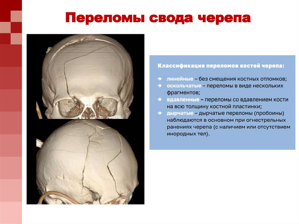 Для перелома основания черепа характерно. Перелом свода основания черепа. Перелом костей свода и основания черепа. При переломе основания черепа. Перелом основания свода черепа последствия.