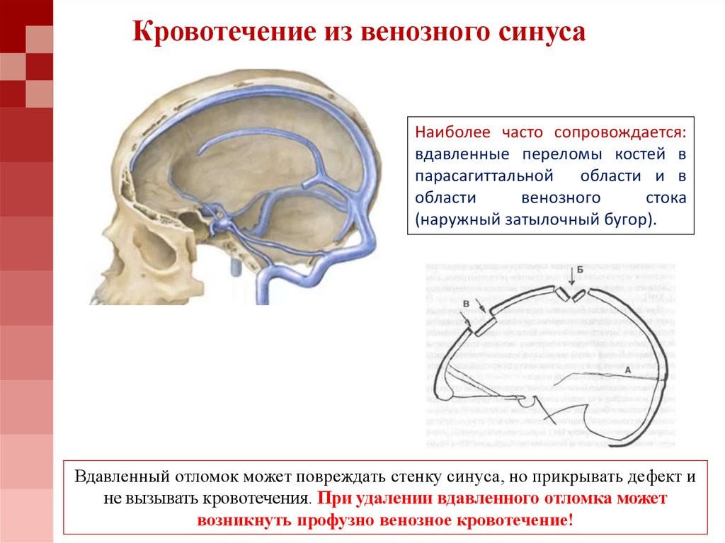 Схема венозных синусов головного мозга