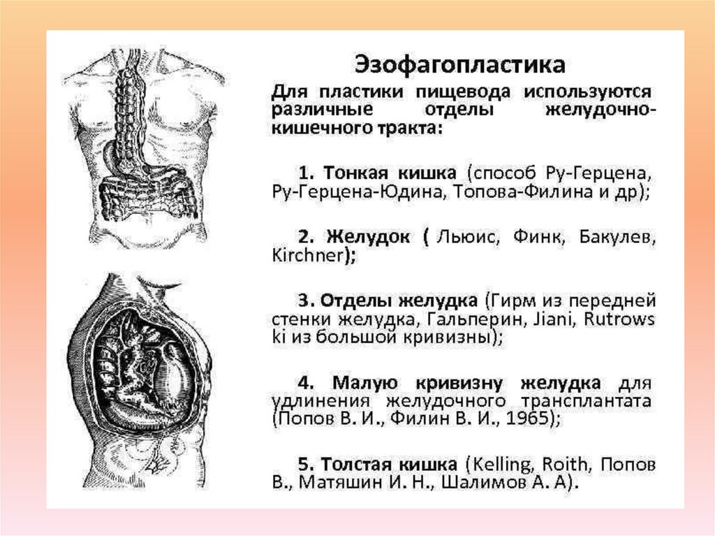 Операция льюиса схема