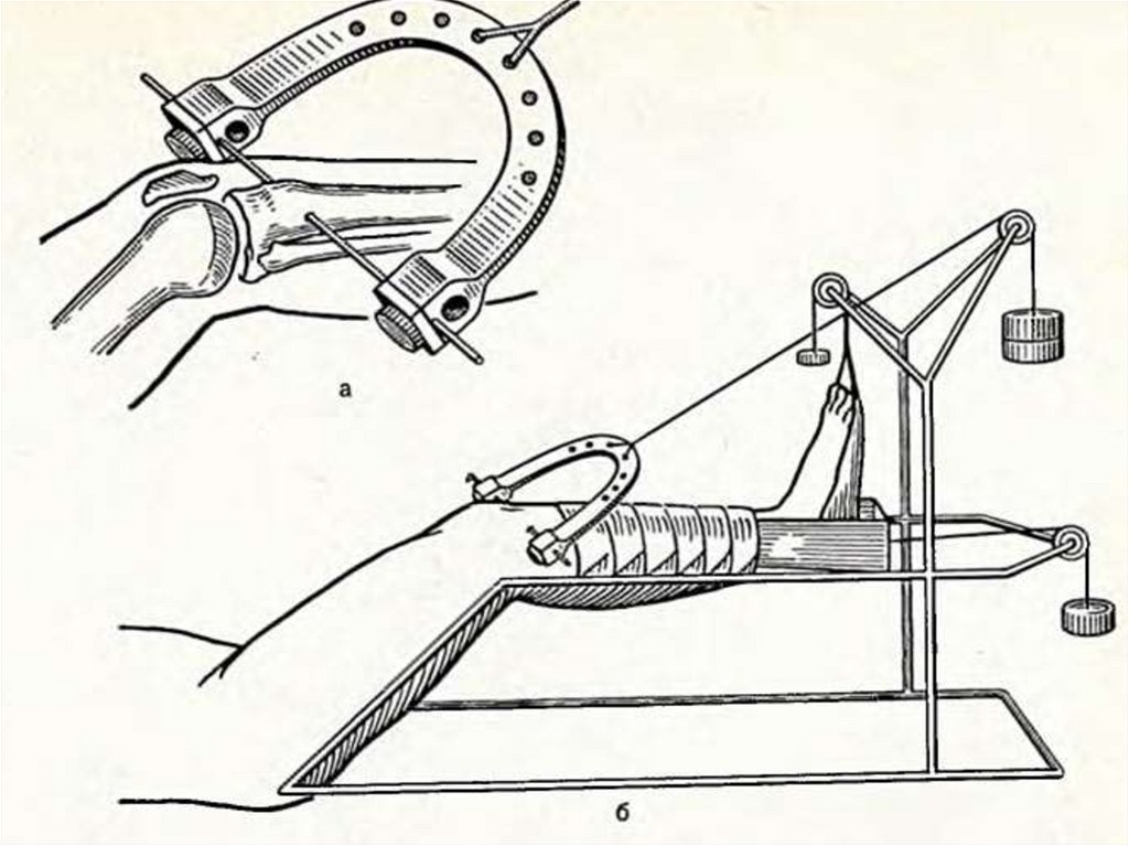 Схема скелетного вытяжения при переломах бедренной кости