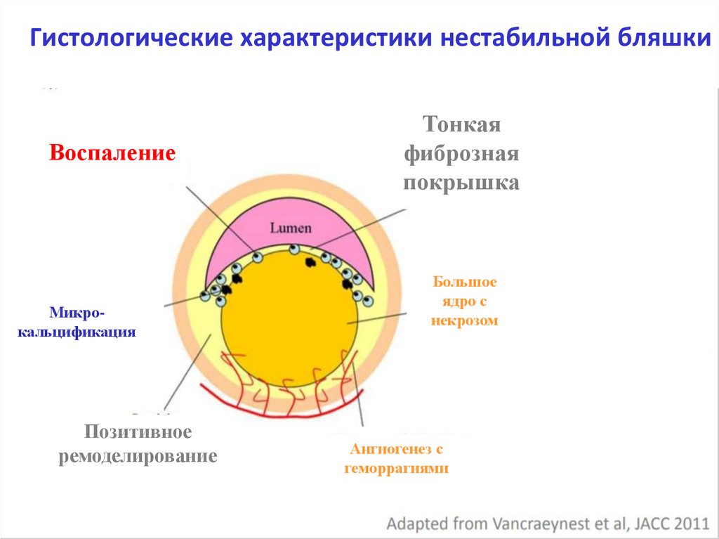 Стабильная и нестабильная бляшка. Строение яйцеклетки человека. Строение яйцеклетки человека схема. Ооцит 2. Фазы ядерного взрыва.