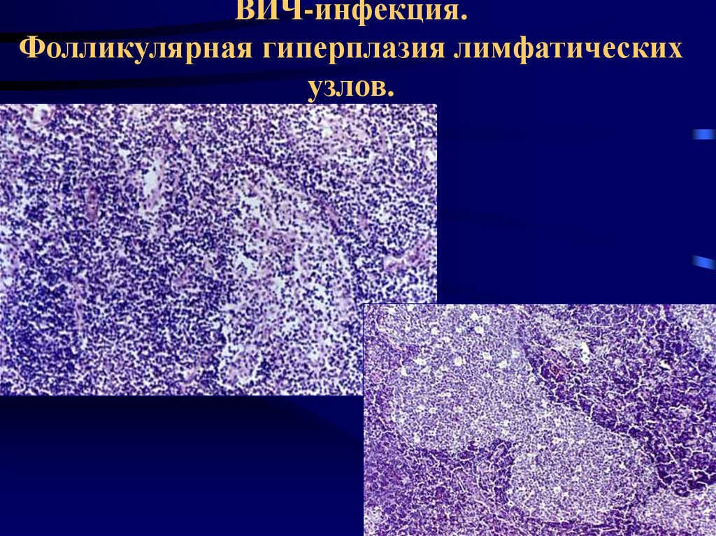 Реактивная гиперплазия лимфоузла. Гиперплазия лимфатического узла микропрепарат. Патологическая анатомия лимфоидной ткани. Гистология ангиофолликулярная гиперплазия. Лимфатический узел при ВИЧ инфекции микропрепарат.