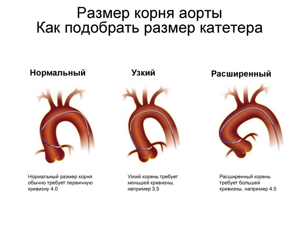 Уплотнение аорты что это значит у женщин