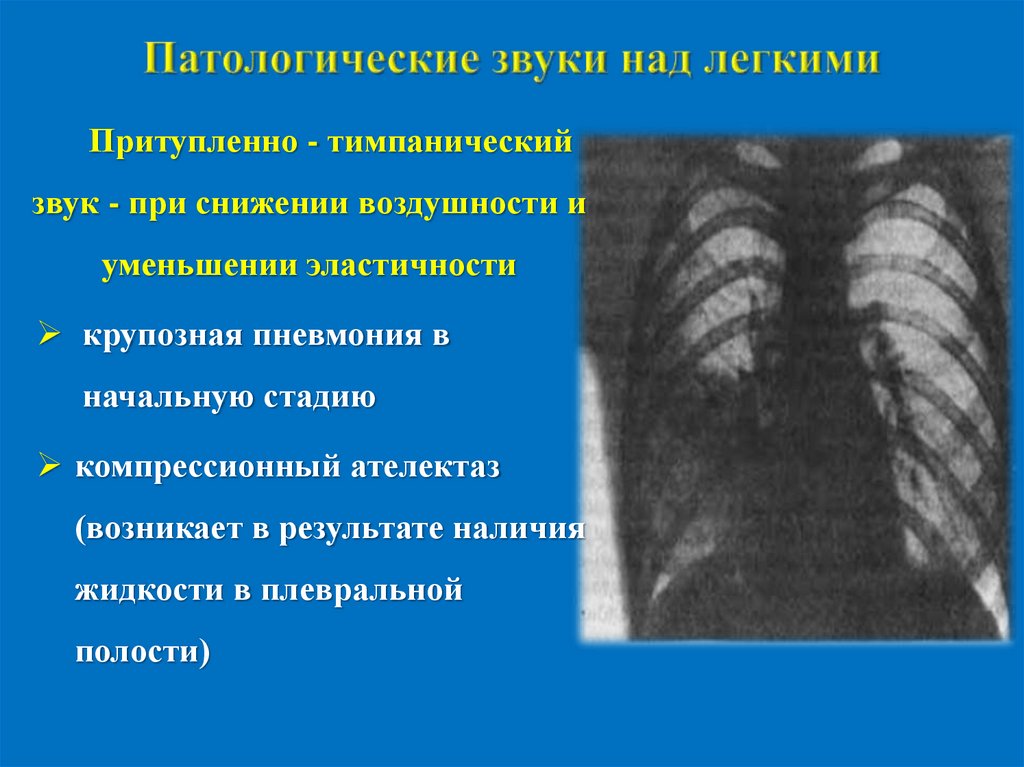 Перкуссия легких презентация