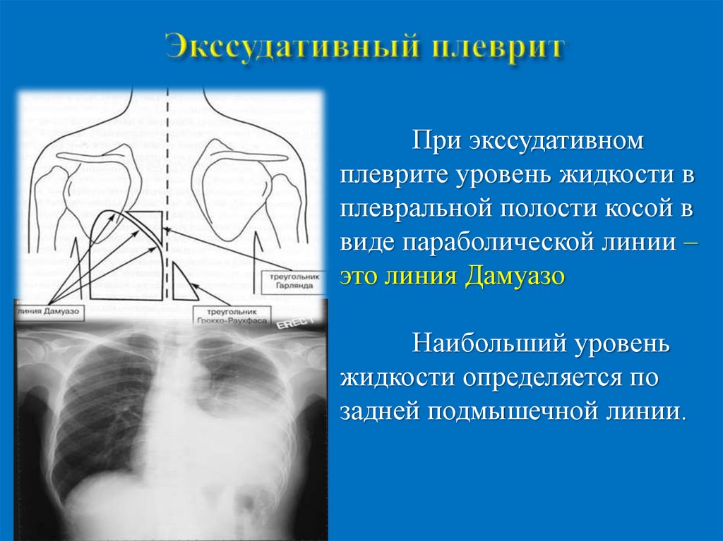 Перкуссия легких презентация