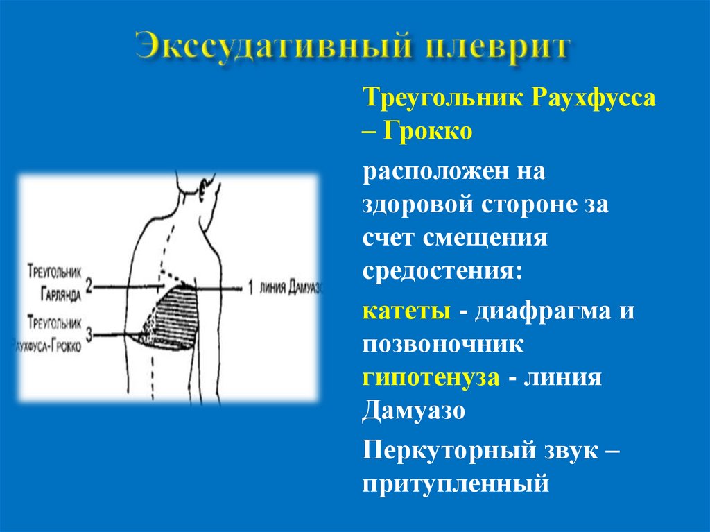 Схема перкуссия легких