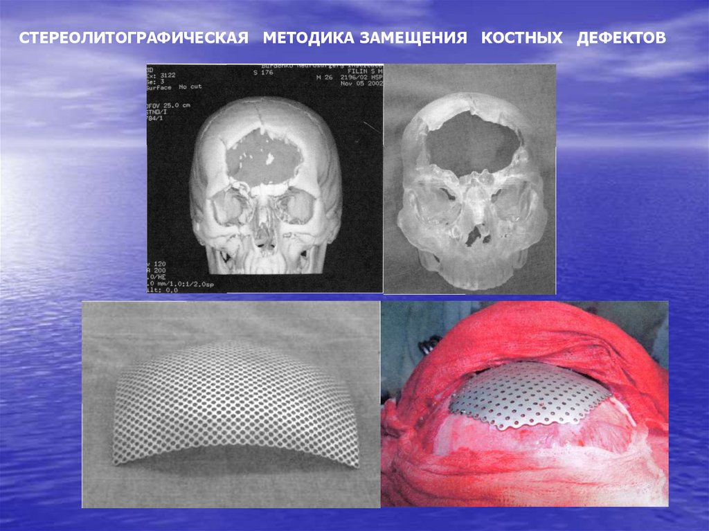 СТЕРЕОЛИТОГРАФИЧЕСКАЯ МЕТОДИКА ЗАМЕЩЕНИЯ КОСТНЫХ ДЕФЕКТОВ