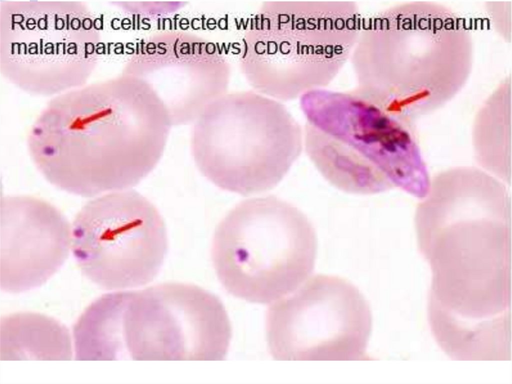 Малярия клетки. Паразит Плазмодиум. Малярия фальципарум. Малярийный плазмодий в толстой капле крови. Plasmodium Vivax заболевание.