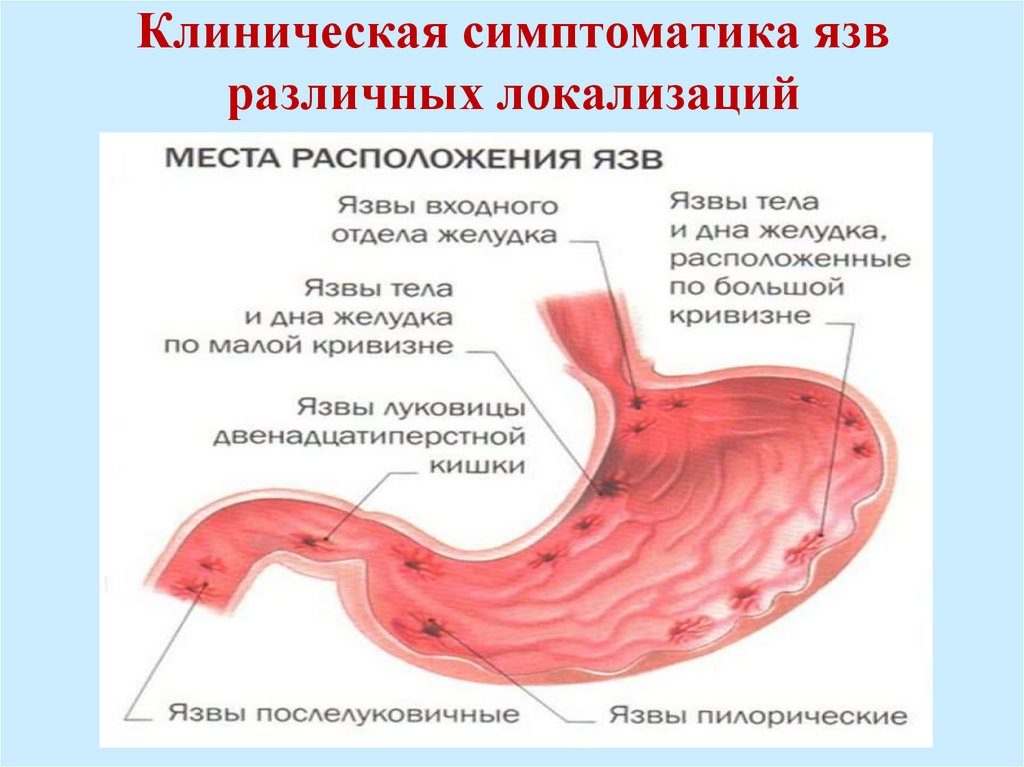 Лечение язвы желудка и 12. Пенетрация язвы в поджелудочную железу. Пенетрация язвы картинки. Первая помощь при пенетрации язвы.