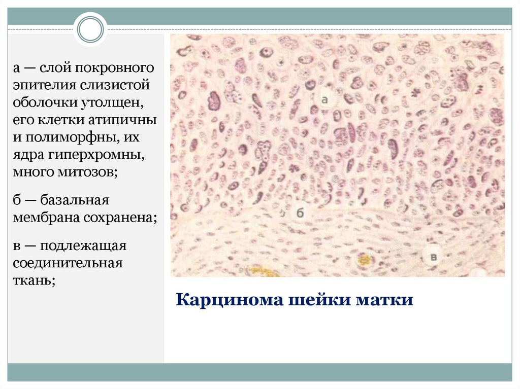 Единичные увеличенные ядра плоского. Опухоли эпителиальной ткани. Атипичные железистые клетки. Опухоли из эпителиальной ткани. Полиморфные клетки гистология.