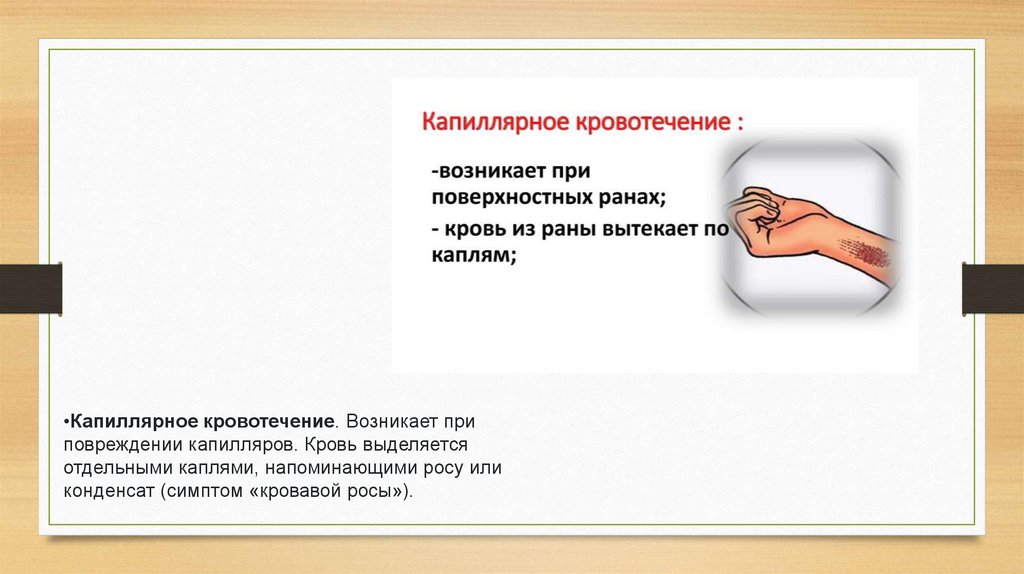 Кровотечения. Виды кровотечений. Первая помощь - презентация онлайн