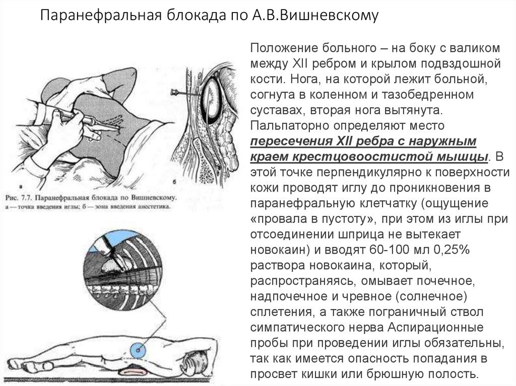 Концентрация новокаина для паранефральной блокады