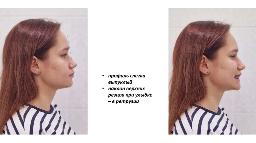 Нейтральная окклюзия - презентация онлайн
