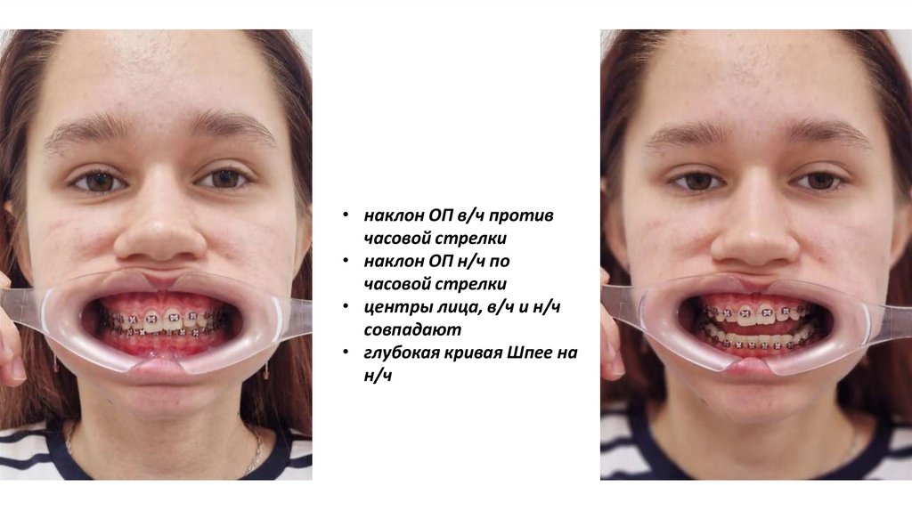 Нейтральная окклюзия - презентация онлайн