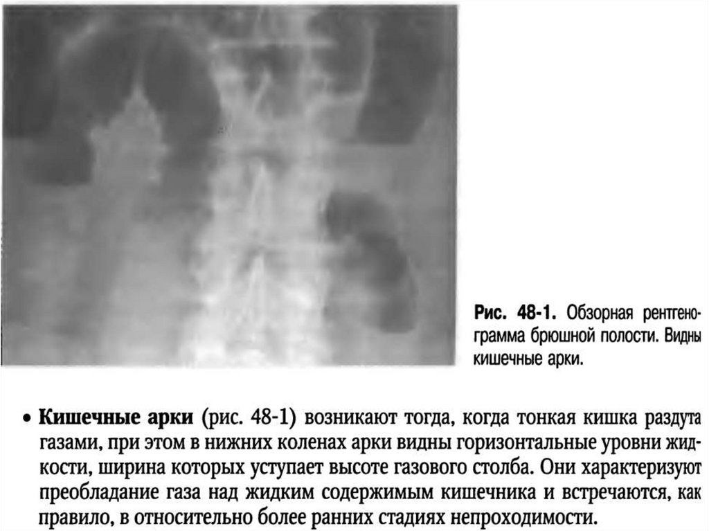 Симптом чаши философова