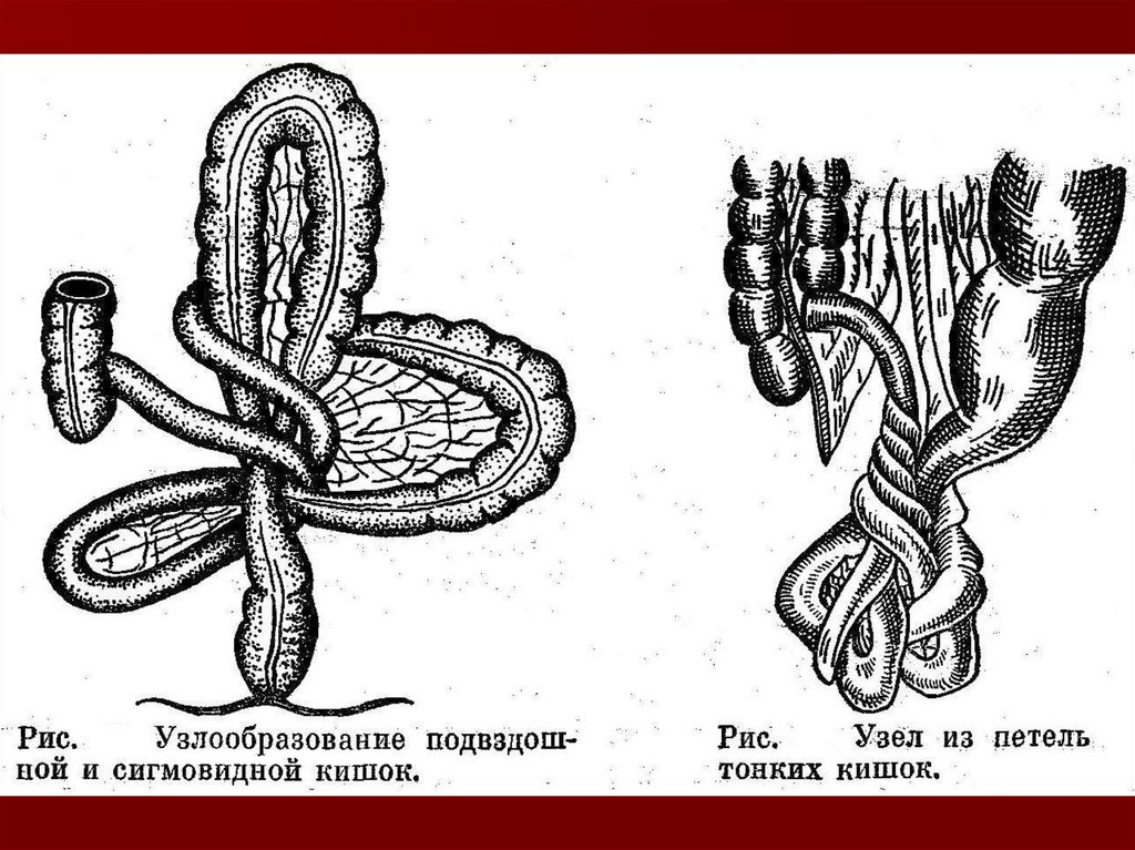 Заворот кишечной непроходимости. Узлообразование кишки. Заворот тонкой кишки схема.