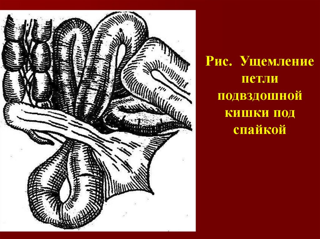 Симптомы заворота кишок. Заворот кишок подвздошной кишки. Некротизированная петля тонкого кишечника. Паретическая петля тонкой кишки. Заворот петель кишечника.