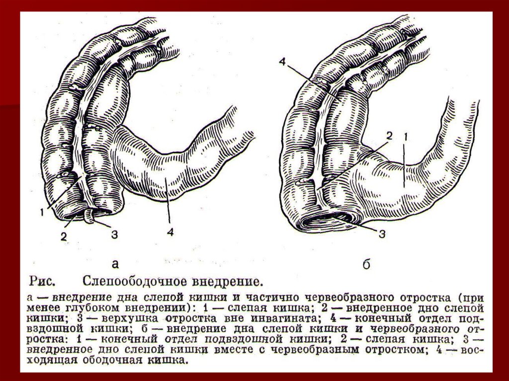 Удаление слепой кишки. Заворот тонкой кишки схема.