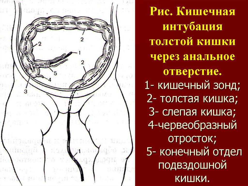 Колоноскопия: показания, подготовка и проведение процедуры