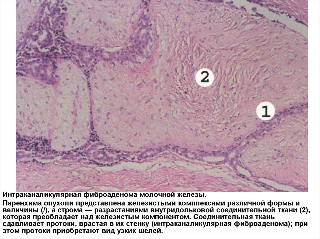 Разрастание ткани. Фиброаденома молочной железы гистология. Интраканаликулярная фиброаденома молочной железы микропрепарат. Интраканаликулярная фиброаденома гистология. Фиброаденома молочной железы микропрепарат.