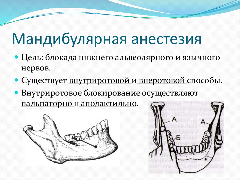 Анестезия по берше. Проводниковая анестезия нижней челюсти торусальная. Метод проведения мандибулярной анестезии. Мандибулярная анестезия нижней челюсти. Мандибулярная анестезия крыловидно нижнечелюстная складка.