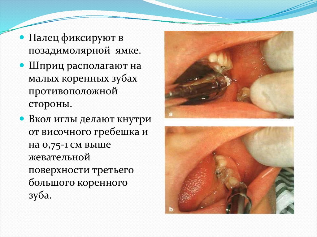 Мандибулярная анестезия - презентация онлайн