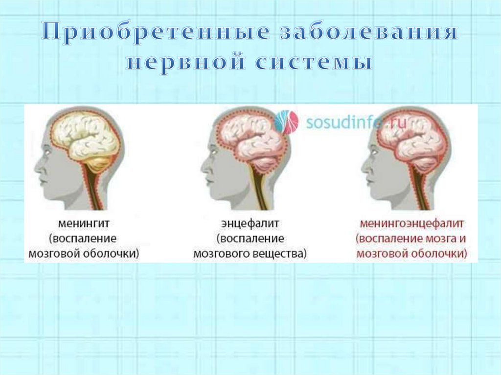 Приобретенные заболевания нервной системы